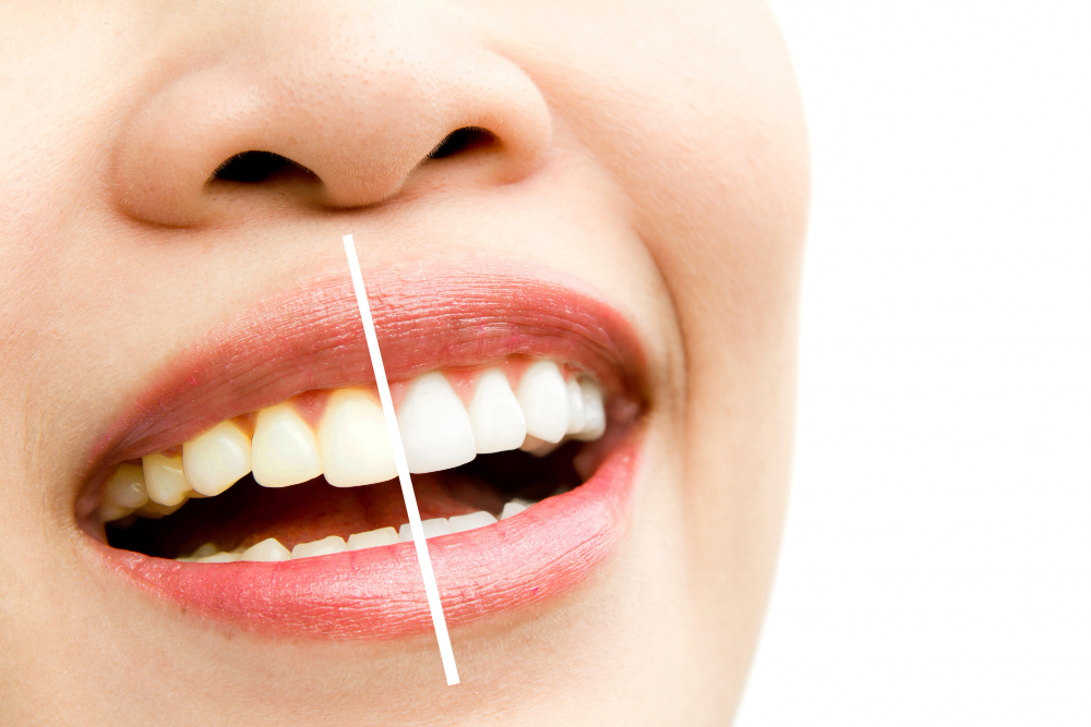 cuánto dura limpieza dental