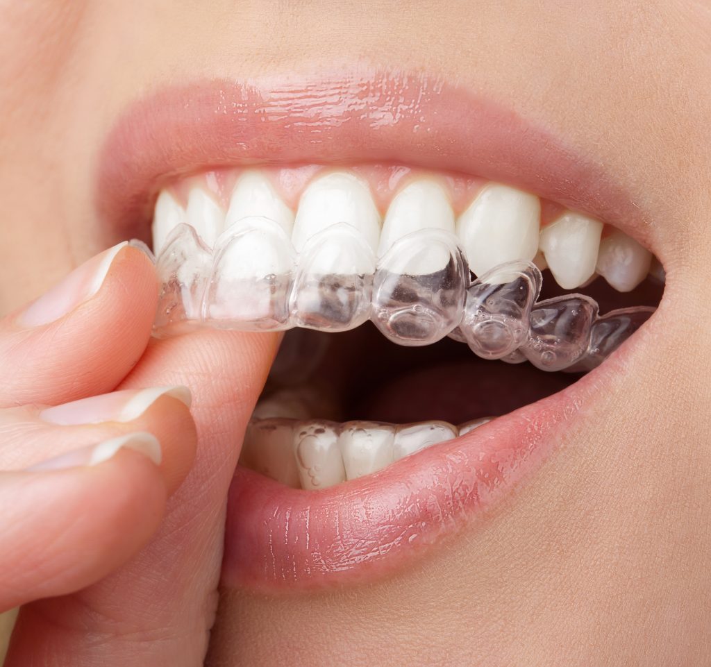 Cuánto tardan en alinearse los dientes