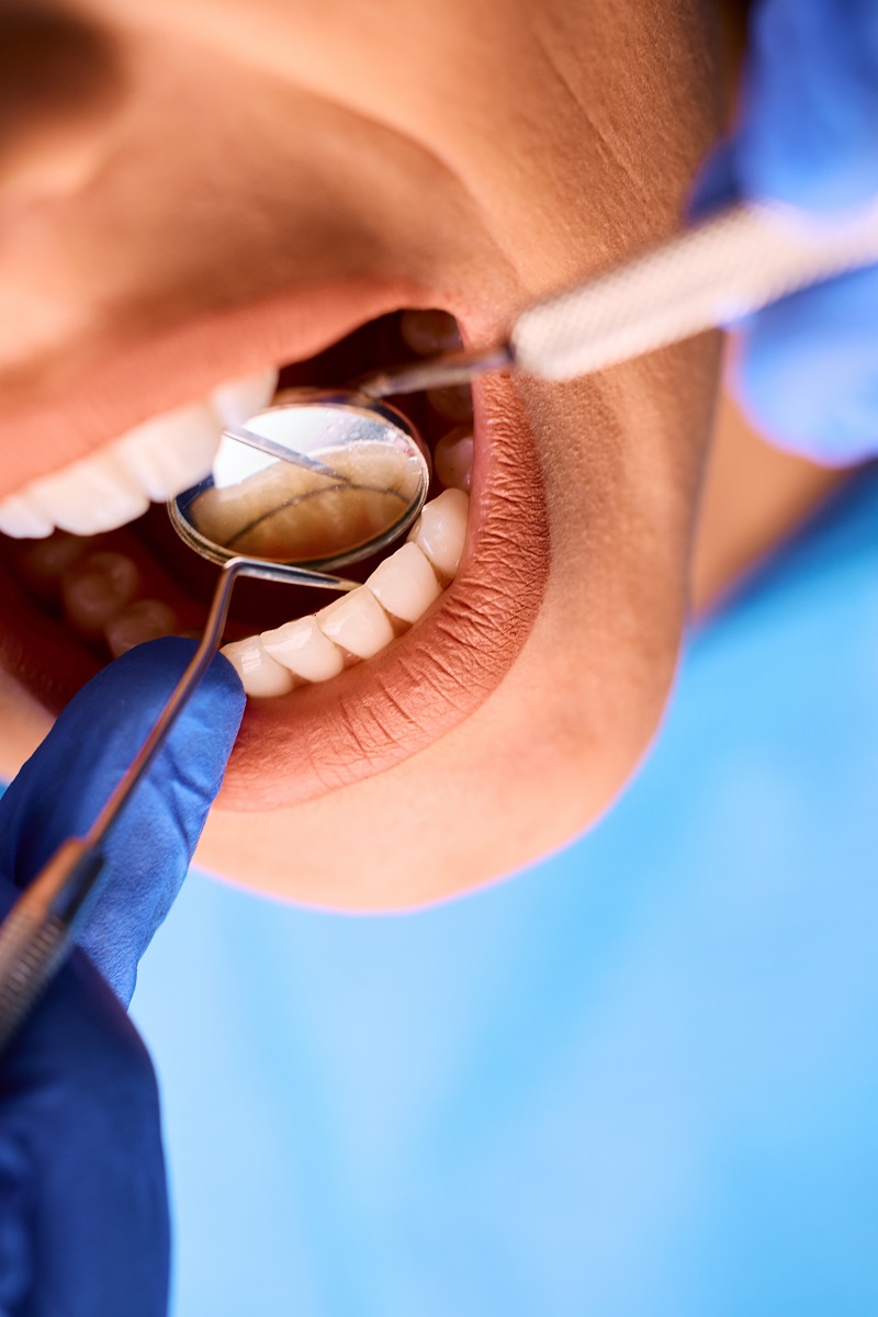 Tratamiento de periodontitis en Mollet del Vallès