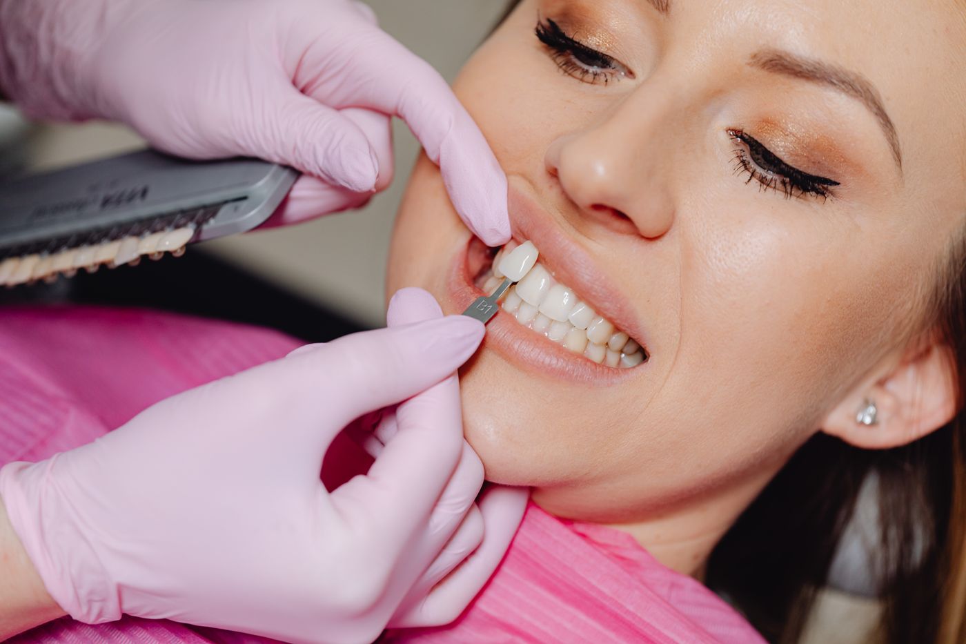 Colocación de una carilla dental para cerrar un hueco pequeño entre dientes