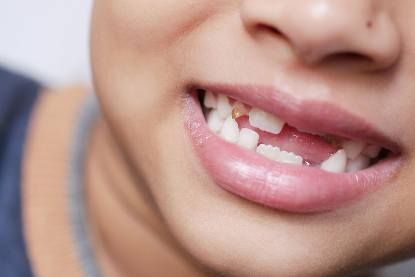 Niño sonriendo con dientes de leche separados