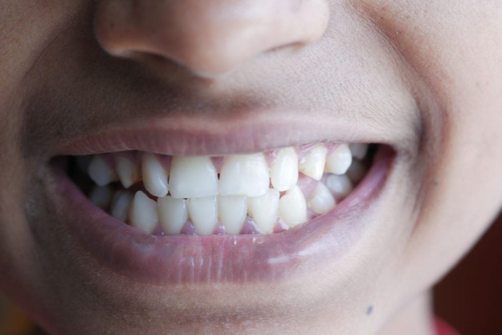 Sonrisa con un diastema, el hueco entre las dos paletas de arriba