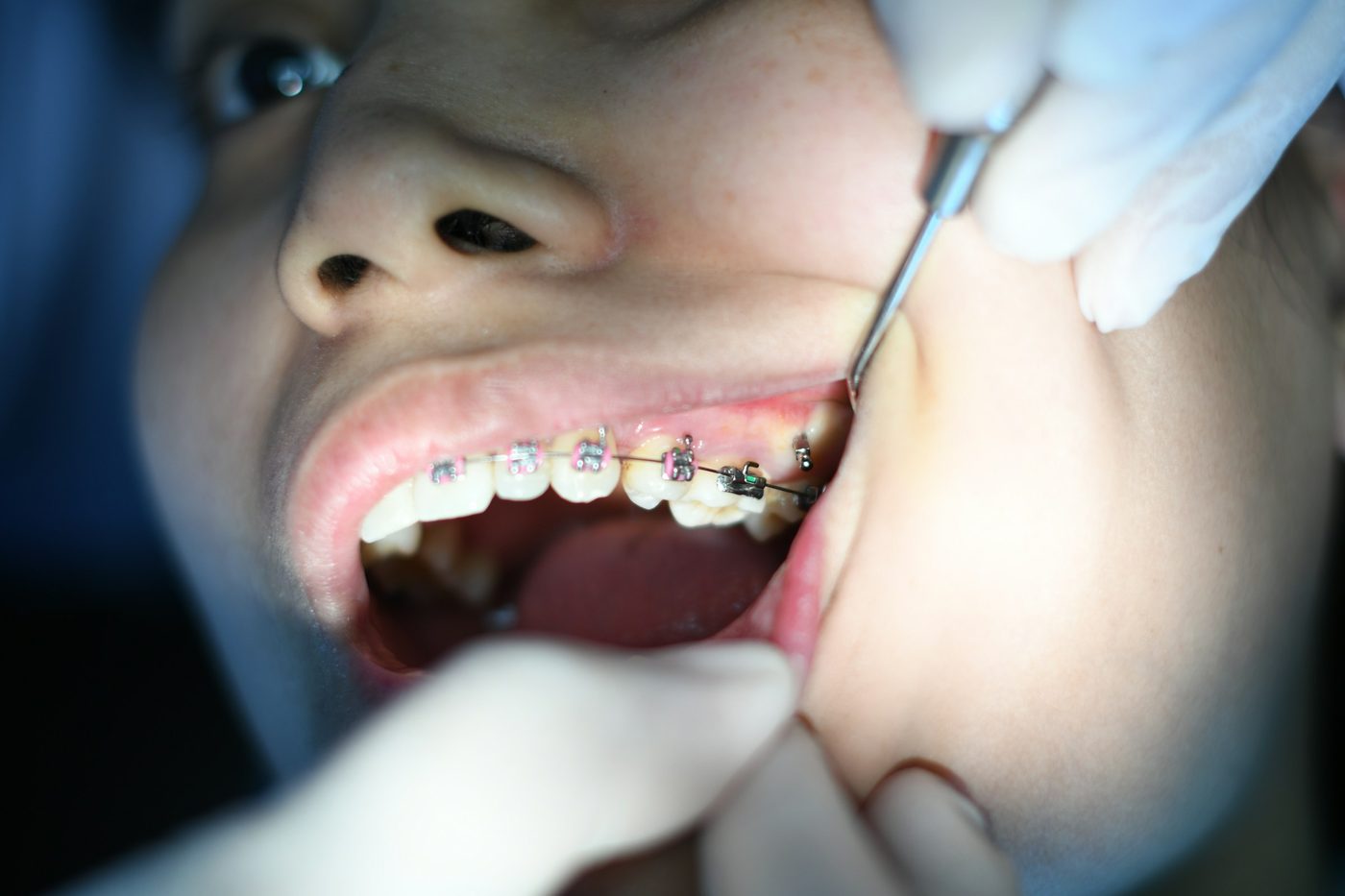 Dentista con guantes revisa los brackets de una paciente con un instrumento