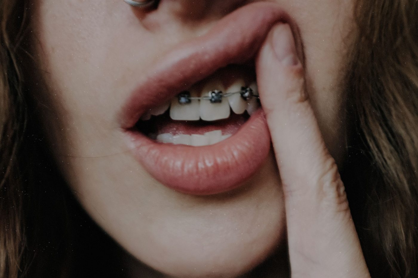 Mujer con brackets metálicos se levanta el labio superior para ver dónde rozan