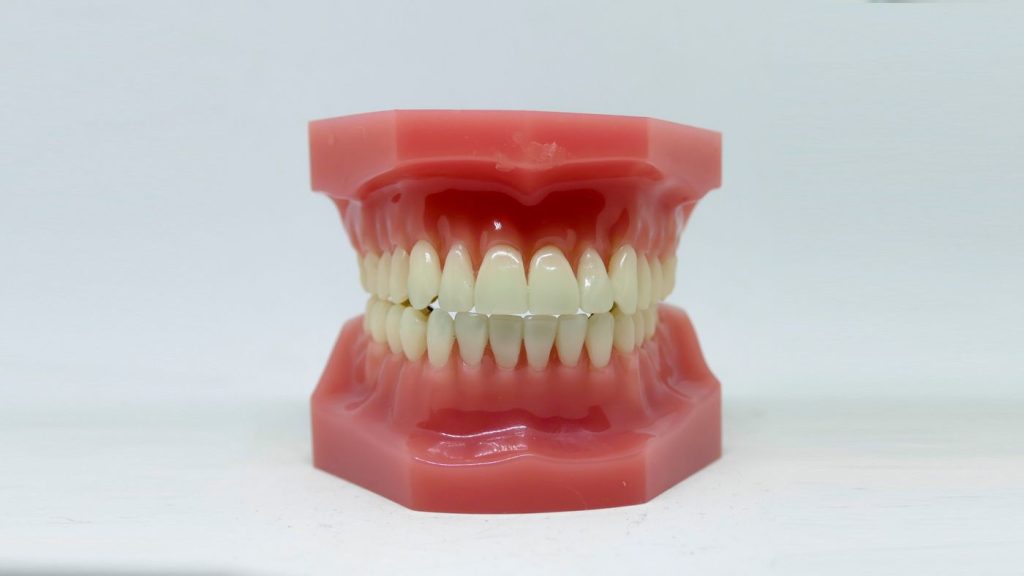 Modelo dental de las dos arcadas en oclusión, para ver cómo encaja la mordida