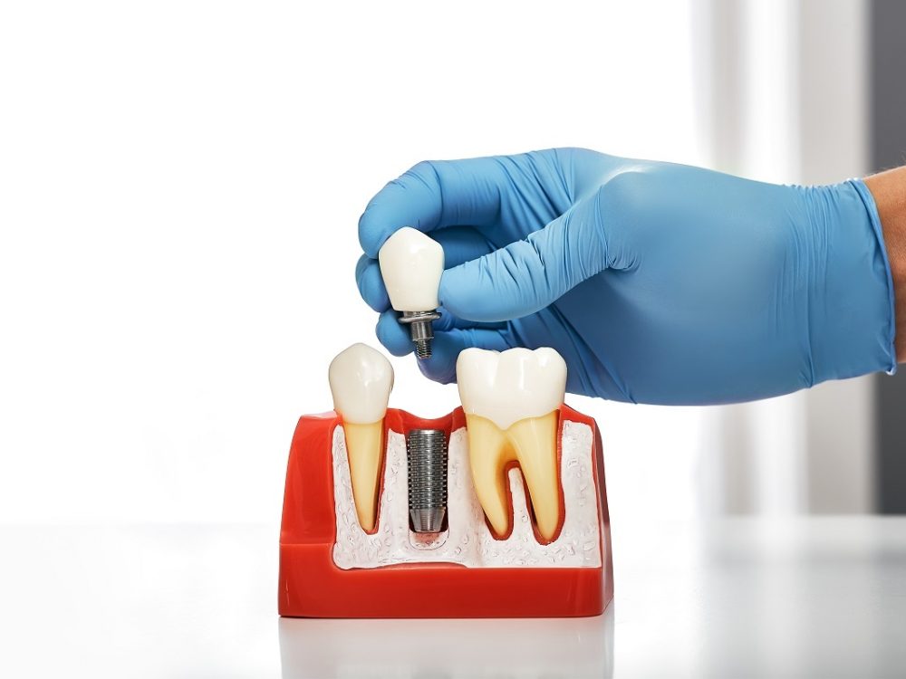 Valoración para implantes de carga inmediata en Mollet del Vallès