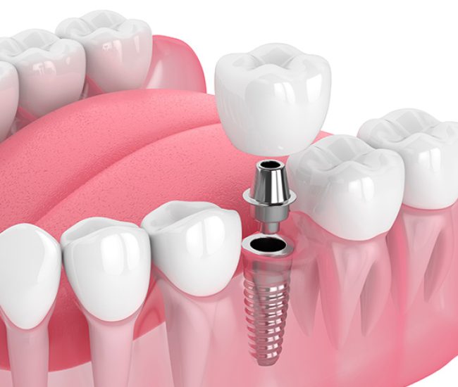 de que material son las coronas de los implantes dentales