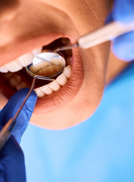 Tratamiento de periodontitis en Mollet del Vallès