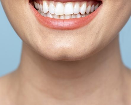 Tratamiento de troneras dentales en Mollet del Vallès para mejorar espacios entre dientes